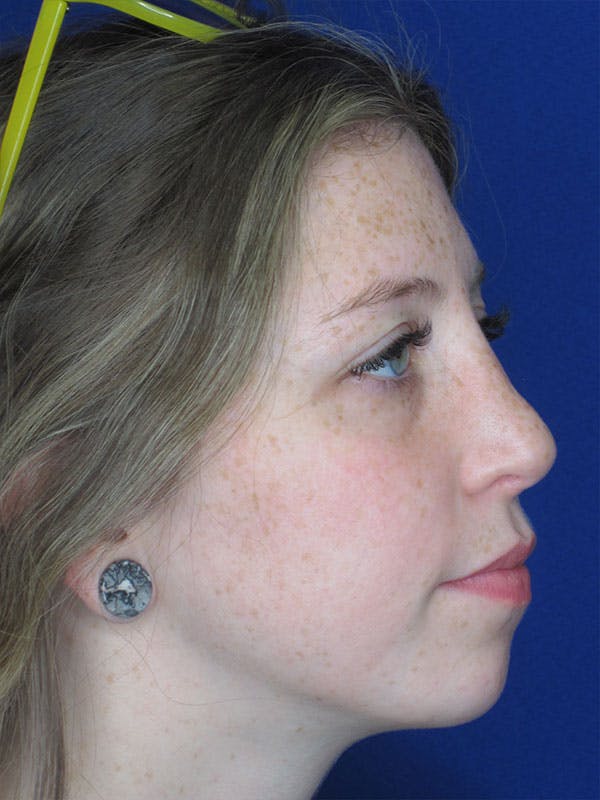 Rhinoplasty Before & After Gallery - Patient 92120380 - Image 2