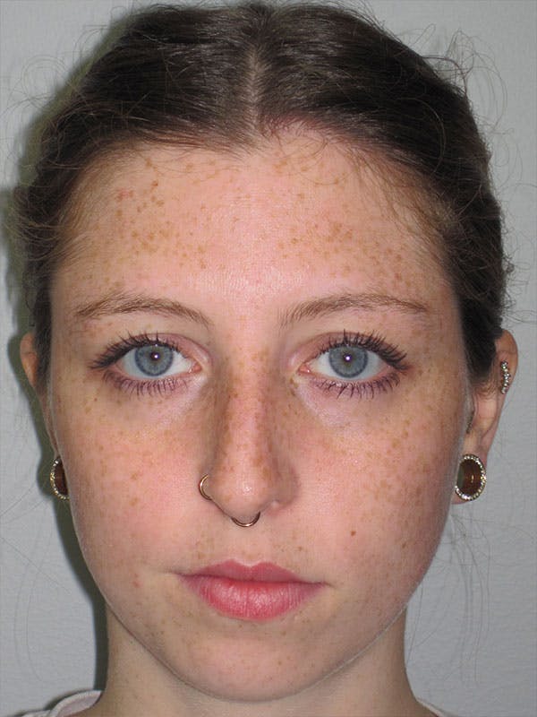 Rhinoplasty Before & After Gallery - Patient 92120380 - Image 3