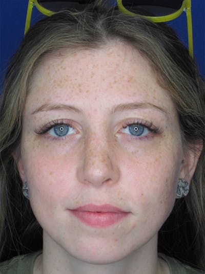 Rhinoplasty Before & After Gallery - Patient 92120380 - Image 4