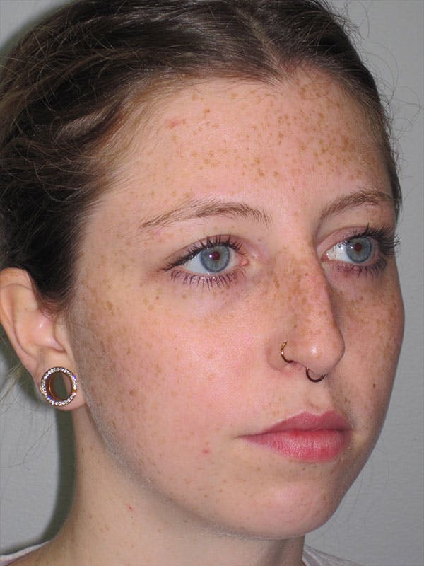 Rhinoplasty Before & After Gallery - Patient 92120380 - Image 5