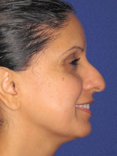 Rhinoplasty Before & After Gallery - Patient 92120381 - Image 1