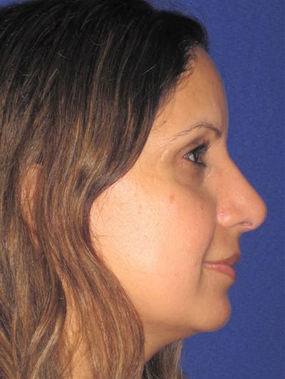 Rhinoplasty Before & After Gallery - Patient 92120381 - Image 2