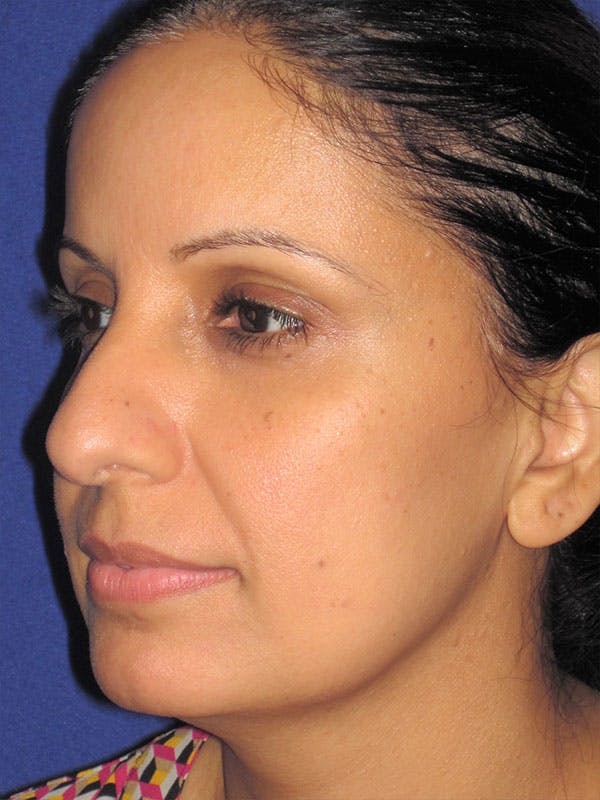 Rhinoplasty Before & After Gallery - Patient 92120381 - Image 3