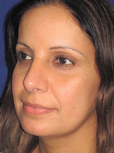 Rhinoplasty Before & After Gallery - Patient 92120381 - Image 4