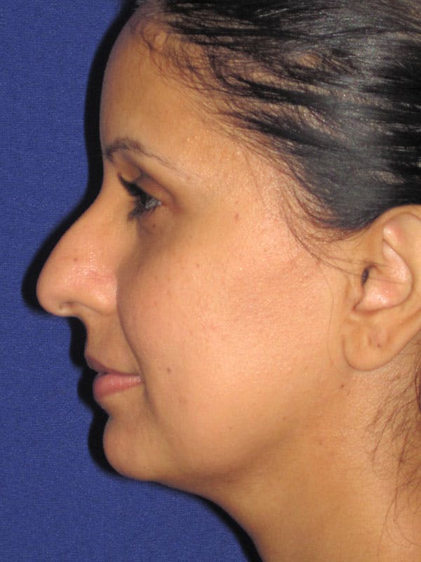 Rhinoplasty Before & After Gallery - Patient 92120381 - Image 5