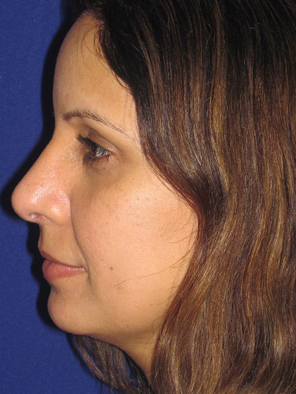 Rhinoplasty Before & After Gallery - Patient 92120381 - Image 6