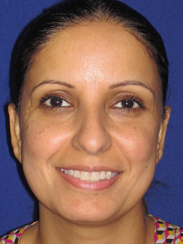 Rhinoplasty Before & After Gallery - Patient 92120381 - Image 7