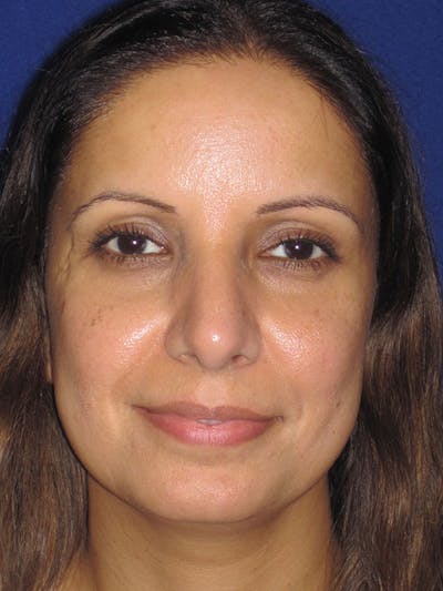 Rhinoplasty Before & After Gallery - Patient 92120381 - Image 8