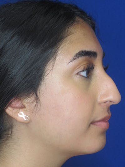 Rhinoplasty Before & After Gallery - Patient 92120384 - Image 1