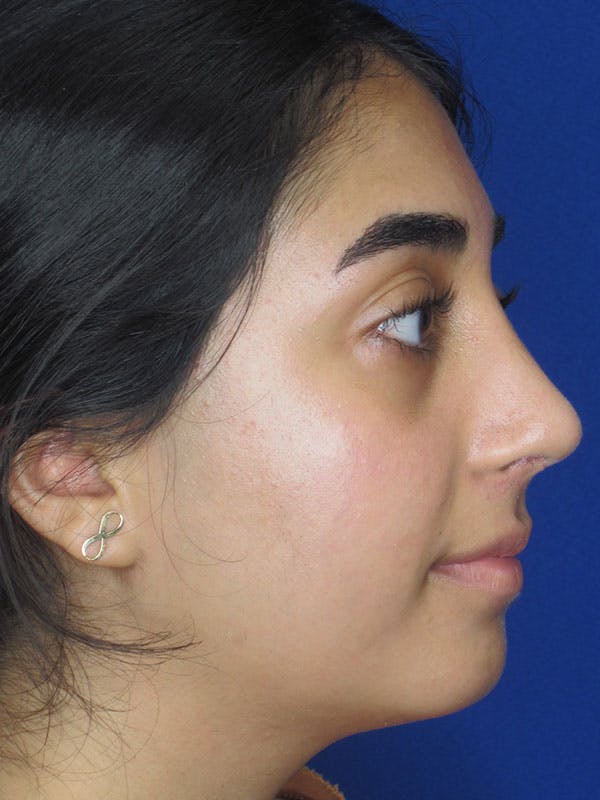 Rhinoplasty Before & After Gallery - Patient 92120384 - Image 2