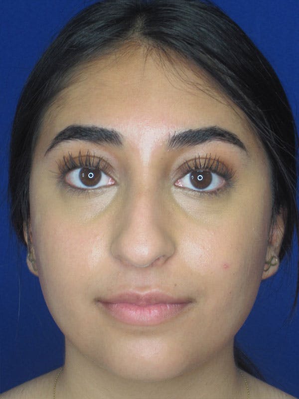 Rhinoplasty Before & After Gallery - Patient 92120384 - Image 3
