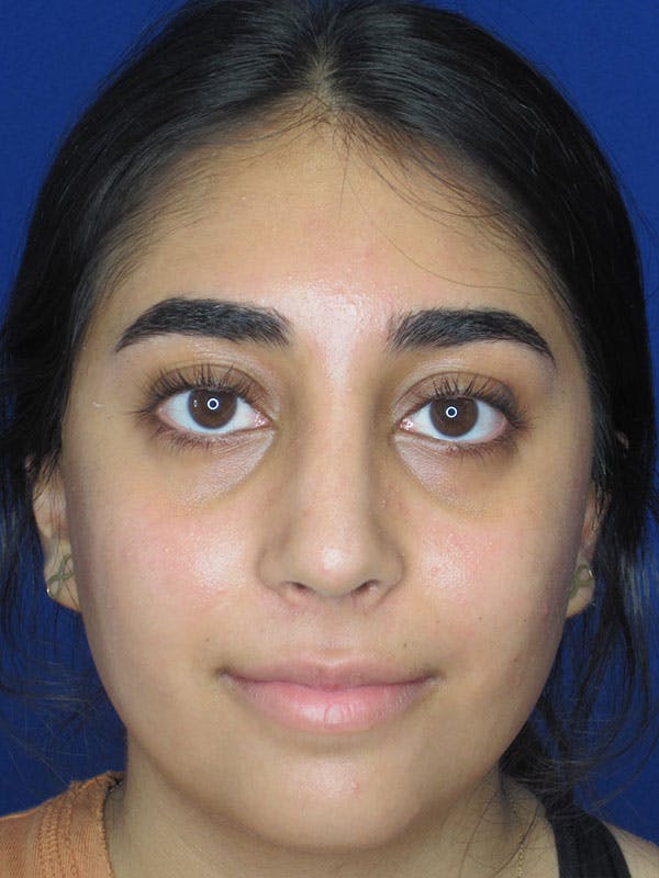 Rhinoplasty Before & After Gallery - Patient 92120384 - Image 4