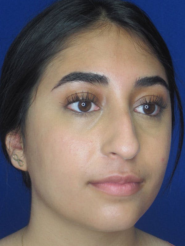 Rhinoplasty Before & After Gallery - Patient 92120384 - Image 5
