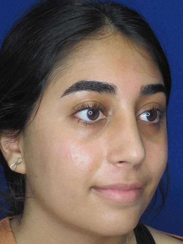 Rhinoplasty Before & After Gallery - Patient 92120384 - Image 6