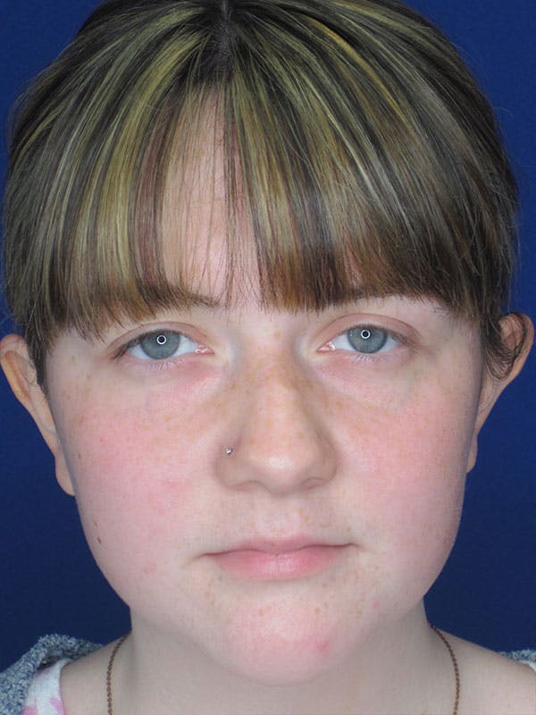 Rhinoplasty Before & After Gallery - Patient 92120413 - Image 1