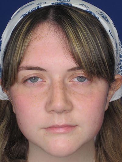 Rhinoplasty Before & After Gallery - Patient 92120413 - Image 2