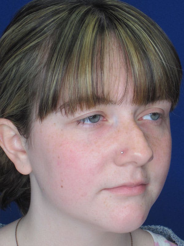 Rhinoplasty Before & After Gallery - Patient 92120413 - Image 3