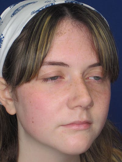 Rhinoplasty Before & After Gallery - Patient 92120413 - Image 4