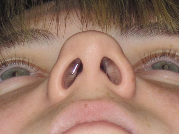 Rhinoplasty Before & After Gallery - Patient 92120413 - Image 5
