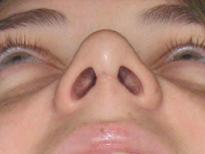 Rhinoplasty Before & After Gallery - Patient 92120413 - Image 6