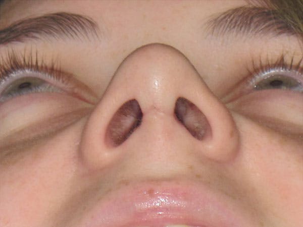 Rhinoplasty Before & After Gallery - Patient 92120413 - Image 6