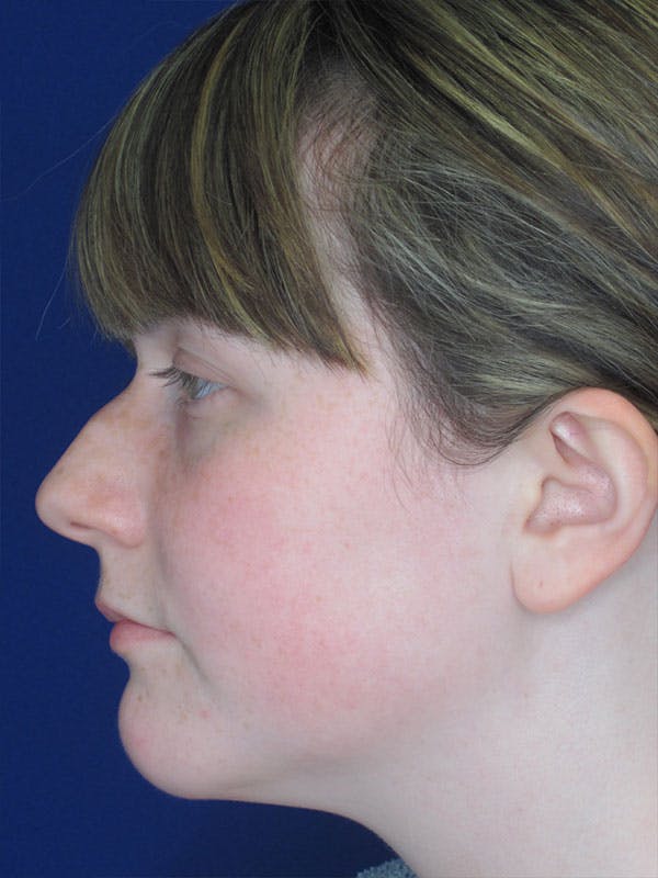 Rhinoplasty Before & After Gallery - Patient 92120413 - Image 7