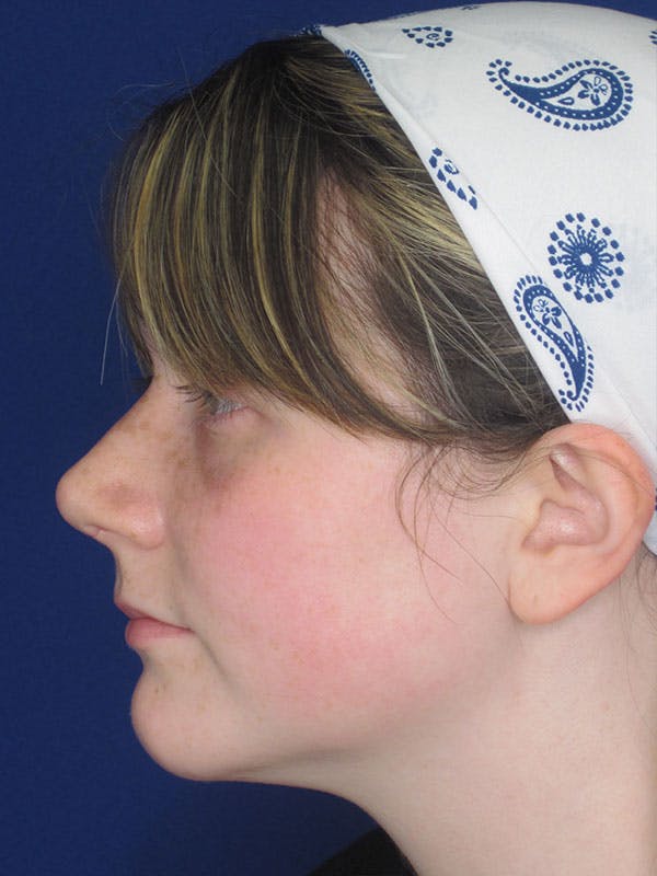 Rhinoplasty Before & After Gallery - Patient 92120413 - Image 8
