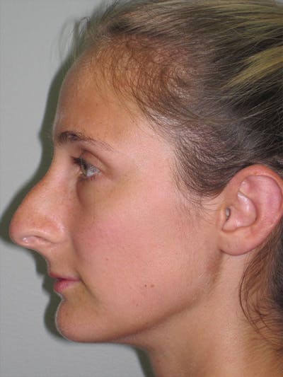 Rhinoplasty Before & After Gallery - Patient 92120451 - Image 1
