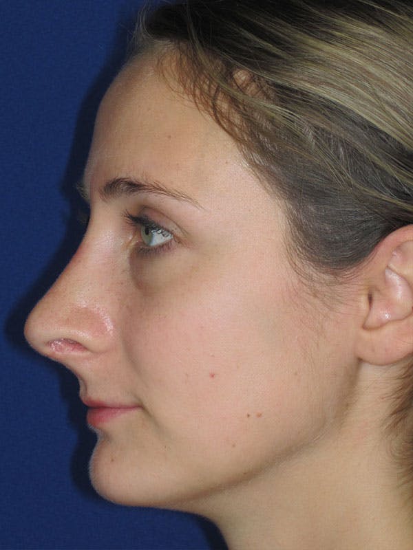 Rhinoplasty Before & After Gallery - Patient 92120451 - Image 2
