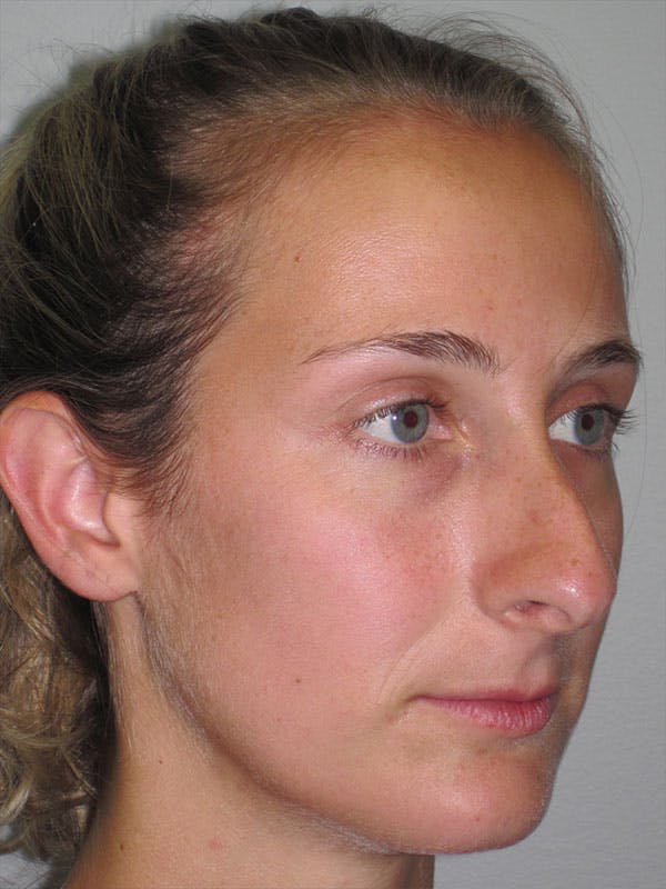 Rhinoplasty Before & After Gallery - Patient 92120451 - Image 3
