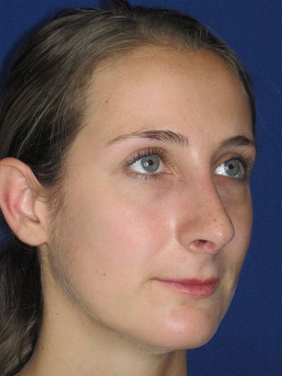 Rhinoplasty Before & After Gallery - Patient 92120451 - Image 4