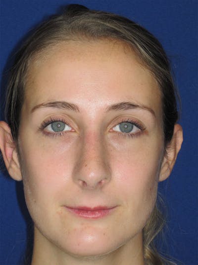 Rhinoplasty Before & After Gallery - Patient 92120451 - Image 6