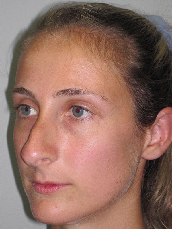 Rhinoplasty Before & After Gallery - Patient 92120451 - Image 7