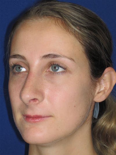 Rhinoplasty Before & After Gallery - Patient 92120451 - Image 8