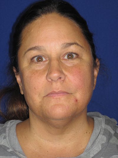 Facelift/Mini-Facelift Before & After Gallery - Patient 121695664 - Image 1