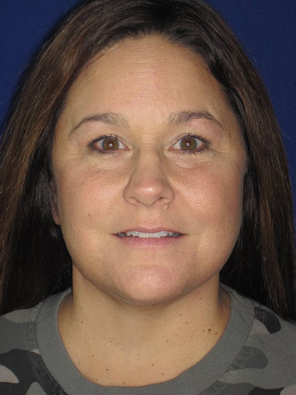 Facelift/Mini-Facelift Before & After Gallery - Patient 121695664 - Image 2