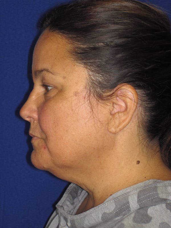 Facelift/Mini-Facelift Before & After Gallery - Patient 121695664 - Image 3