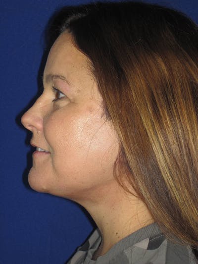 Facelift/Mini-Facelift Before & After Gallery - Patient 121695664 - Image 4