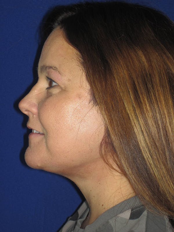 Facelift/Mini-Facelift Before & After Gallery - Patient 121695664 - Image 4