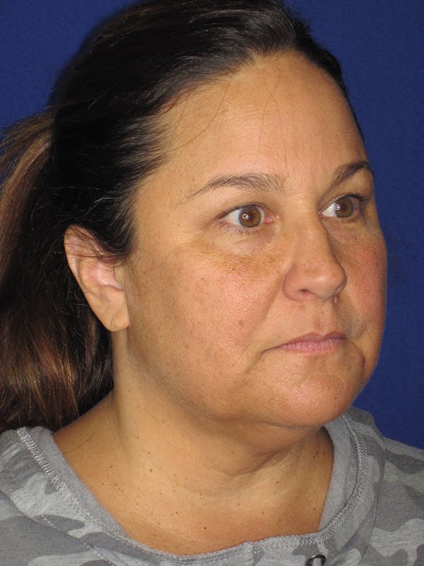 Facelift/Mini-Facelift Before & After Gallery - Patient 121695664 - Image 5