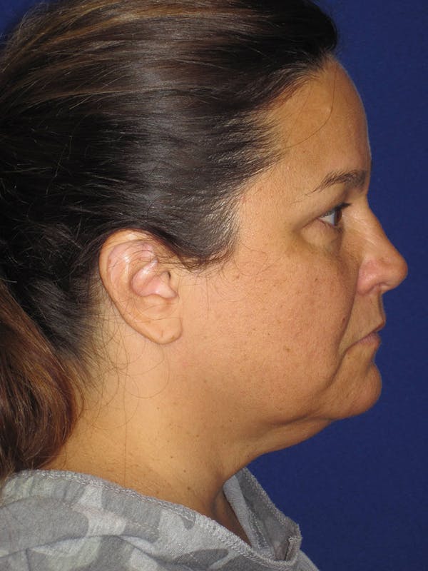 Facelift/Mini-Facelift Before & After Gallery - Patient 121695664 - Image 7