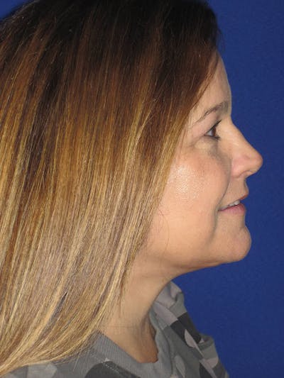 Facelift/Mini-Facelift Before & After Gallery - Patient 121695664 - Image 8
