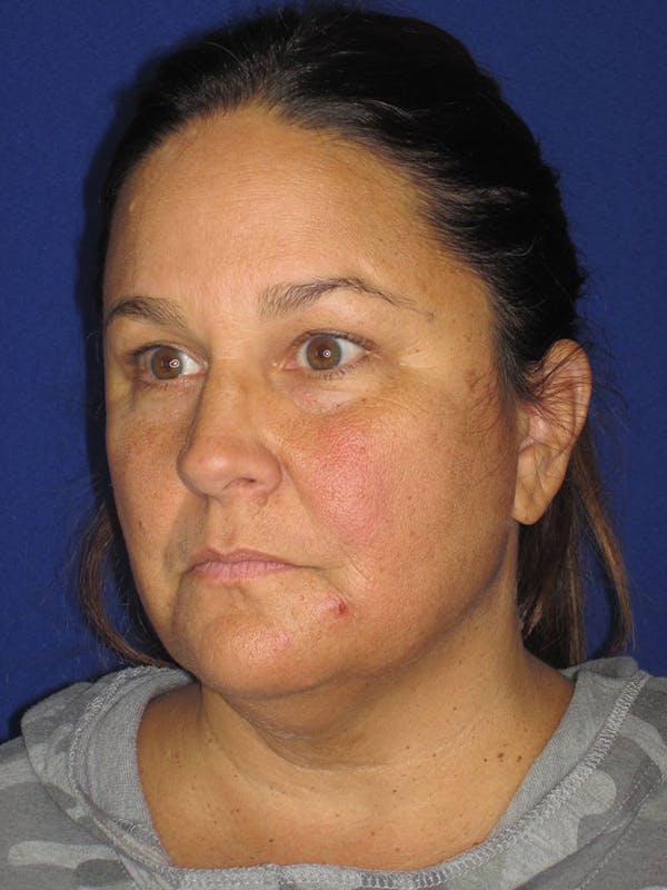 Facelift/Mini-Facelift Before & After Gallery - Patient 121695664 - Image 9
