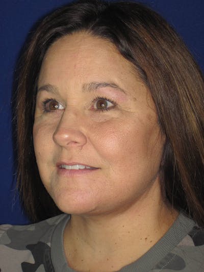 Facelift/Mini-Facelift Before & After Gallery - Patient 121695664 - Image 10
