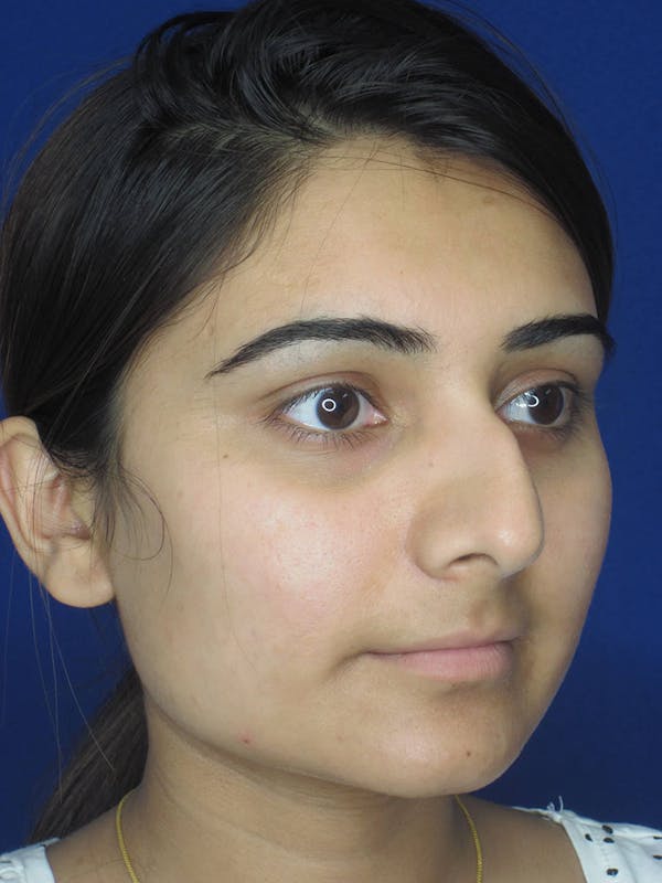 Rhinoplasty Before & After Gallery - Patient 165416668 - Image 1