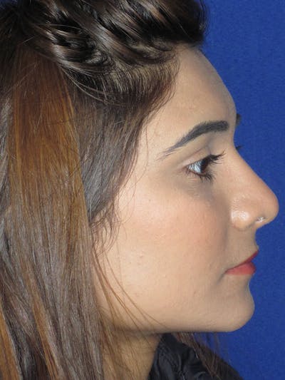 Rhinoplasty Before & After Gallery - Patient 121695954 - Image 4