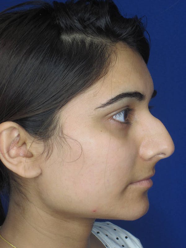 Rhinoplasty Before & After Gallery - Patient 121695954 - Image 3
