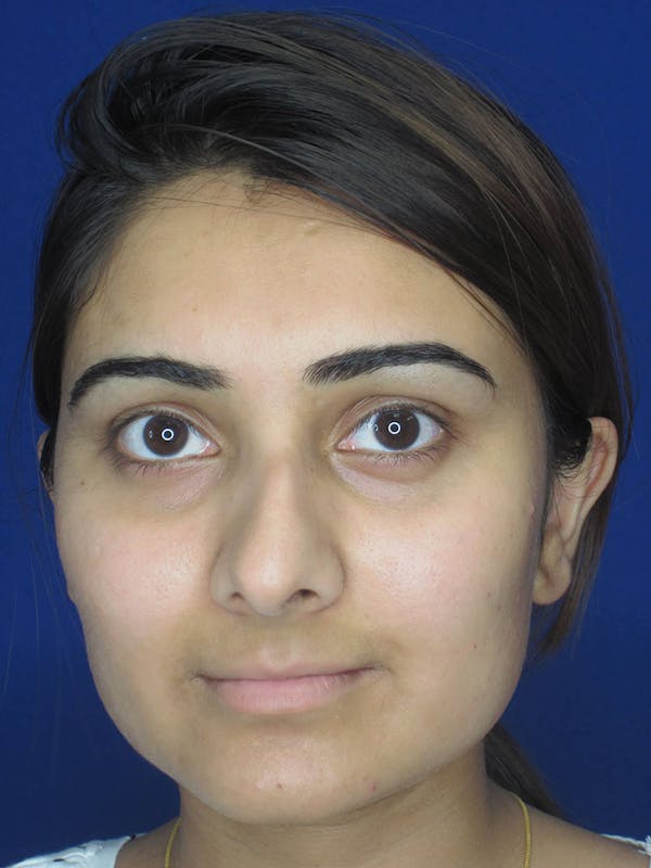 Rhinoplasty Before & After Gallery - Patient 165416668 - Image 5