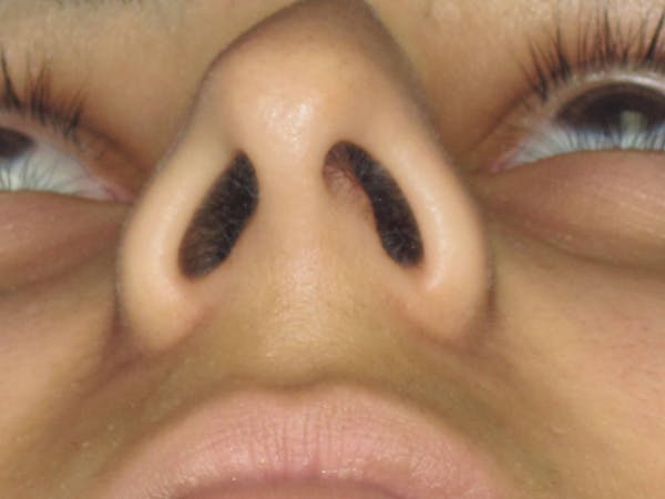 Rhinoplasty Before & After Gallery - Patient 165416668 - Image 7