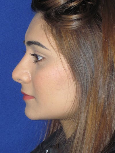 Rhinoplasty Before & After Gallery - Patient 165416668 - Image 10